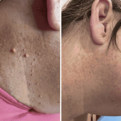 Painless Skin Tag Removal Kit