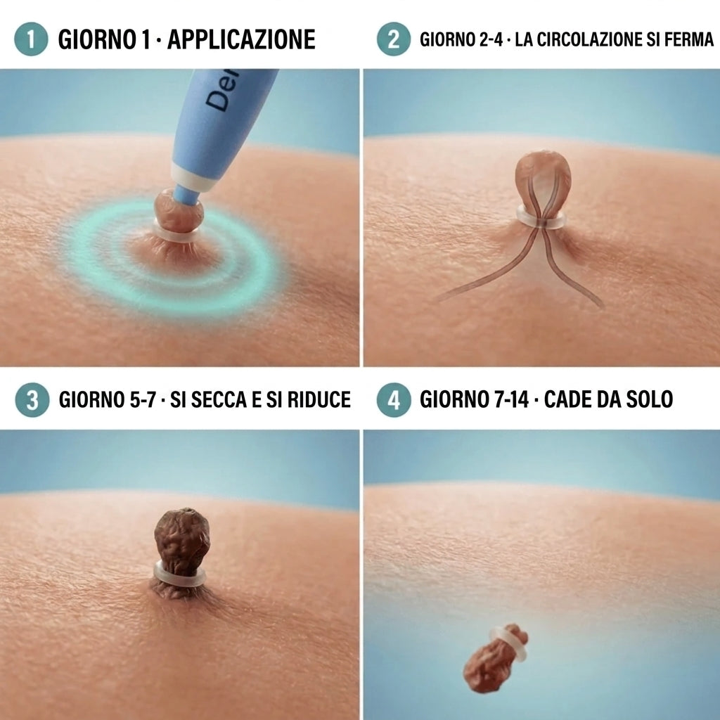 Painless Skin Tag Removal Kit