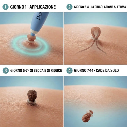 Painless Skin Tag Removal Kit